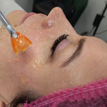 Апаратна карбоксітерапія
                    Косметолог Міла Київ