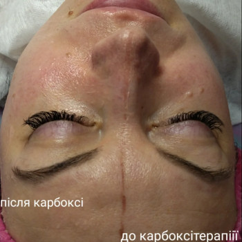 Апаратна карбоксітерапія
                    Косметолог Міла Київ