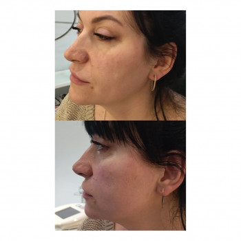 Апаратна карбоксітерапія
                    Косметолог Міла Київ