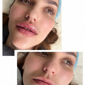 Контурна пластика губ
                    Косметолог-инъекционист Світлана Каменец-Подольский