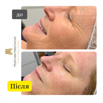Лазерне фракційне 4D омолодження
                    Косметологический центр Клініка естетичної медицини Мирослави Новосільської Ужгород