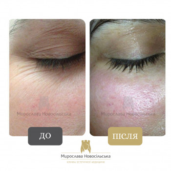Лазерне фракційне 4D омолодження
                    Косметологический центр Клініка естетичної медицини Мирослави Новосільської Ужгород
