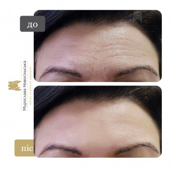 Лазерне фракційне 4D омолодження
                    Косметологический центр Клініка естетичної медицини Мирослави Новосільської Ужгород