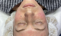 Мезотерапія для активації клітин Косметологический центр WE Cosmetology Киев