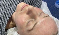 Мезотерапія з ліфтинг-ефектом Косметологический центр WE Cosmetology Киев