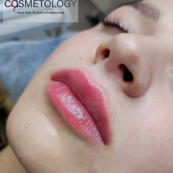 Аугментація губ (збільшення губ) від косметолога Наталії Філь

   