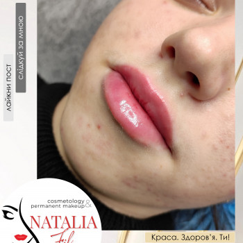 Аугментація губ (збільшення губ) від косметолога Наталії Філь

   