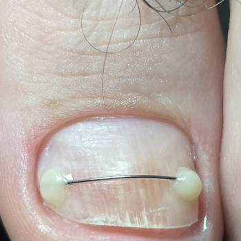 Встановлення титанової нитки