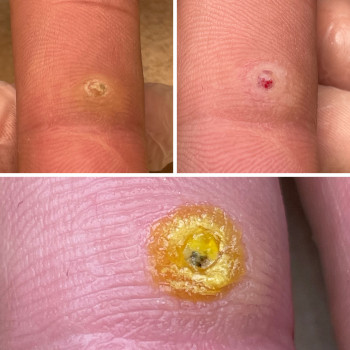 Видалення бородавки на пальці руки