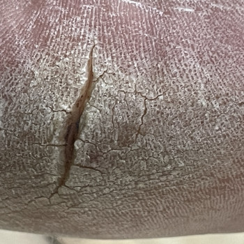 Обробка тріщини п‘ят