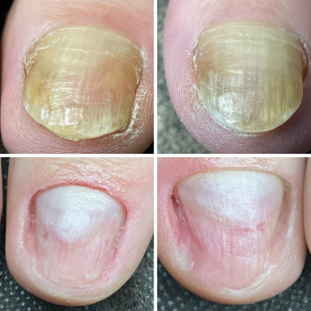 Зачистка оніхомікозу