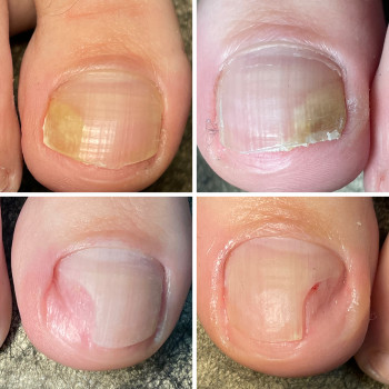 Зачистка оніхолізісу