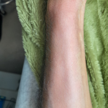 Після( відразу після процедури).