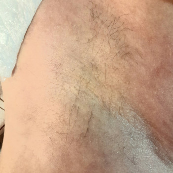 25лютого- перед другою процедурою.