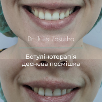 ботулинотерапия