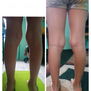 Лікувальний масаж з ЛФК для дітей при вальгусній деформації ніг та плоскостопості/Лечебный массаж с ЛФК при вальгусной деформации ног и плоскостопии
                    Массажист Ирина Днепр