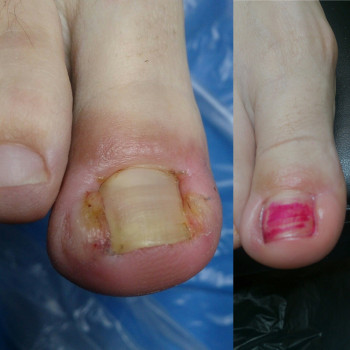 Коррекція вростаючої нігтьової пластини