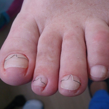 Коррекція вростаючої нігтьової пластини за допомогою корекці