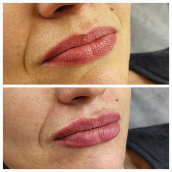 Увеличение губ, препарат. STYLAGE M, 0.8мл. До и сразу после