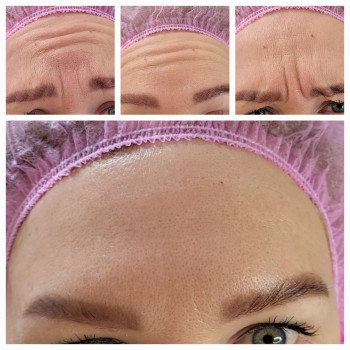 Убираем негативную мимику, профилактируем появление заломов