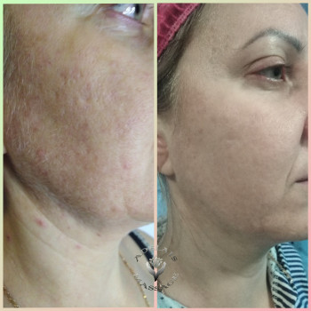 Саліцилово- гліколієвий пілінг