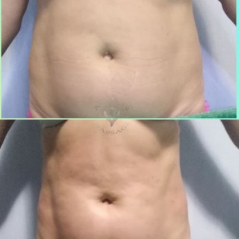 УЗ ліполіз
                    Масажист Юлія Київ