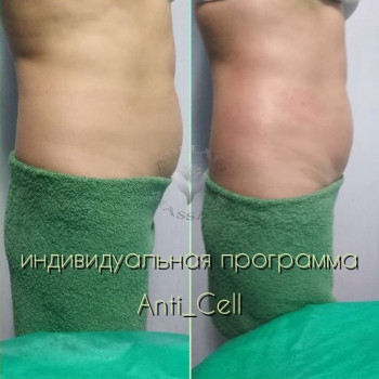 Результат 2х процедур