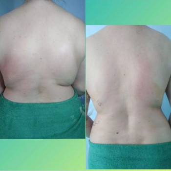 Результат 3х процедур