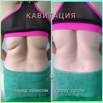 одразу після кавітації. Результат 2х процедур