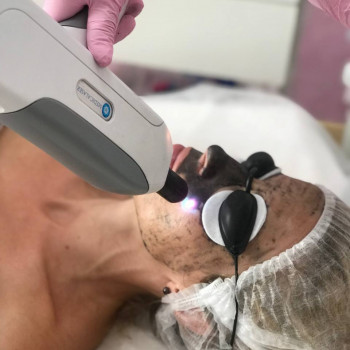 Процедура "корбоновий пілінг"