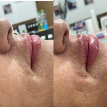 Контурна пластика губ препаратом - E.P.T.Q.