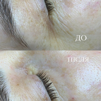 Результат за 1 процедуру + екстракція міліума, фото - дерматолог косметолог Анастасія Бондаренко