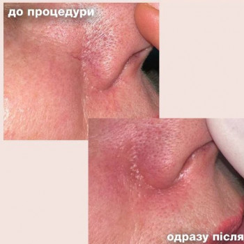 видалення куперозу (судинної сітки) IPL Lumeca