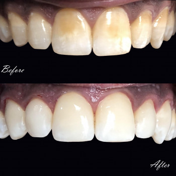 Художня реставрація 6 зубів