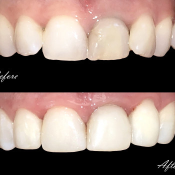 Художня реставрація 4 зубів