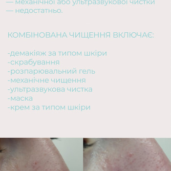 Комбінована чистка
                    Косметолог Алла Кременчуг