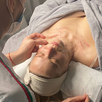 Face Lifting Acupuncture (голки)
                    Масажист Николай Київ
