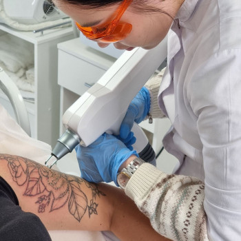 Видалення татуювання та татуажу лазером
                    Косметолог Анастасия Киев