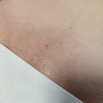 Шугаринг, шугарінг
                    Майстер депіляції Яна Жмеринка