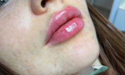 Контурна пластика губ 💋 Косметолог Людмила Бровари