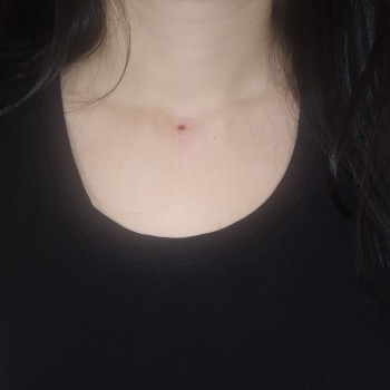 Мікродермал - 1200 грн ((ціна вже з прикрасою)