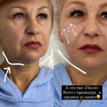 Увеличение губ / контурная пластика губ
                    Косметолог-инъекционист Анастасия Киев