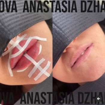 Увеличение губ / контурная пластика губ
                    Косметолог-инъекционист Анастасия Киев