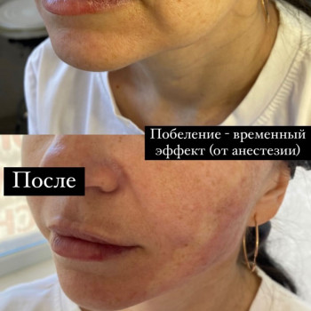 Увеличение губ / контурная пластика губ
                    Косметолог-инъекционист Анастасия Киев