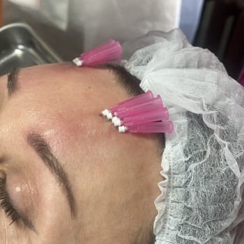 Біоармування зони чола