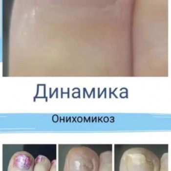 Оніхомікоз
 
 
 
 
 
 