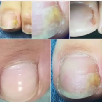 Оніхомікоз
 
 
 
 
 
 