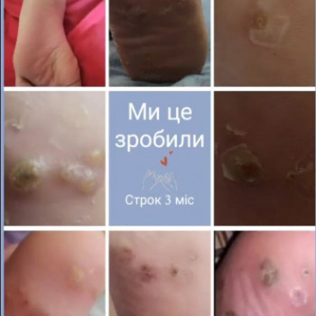 Вірусні бородавки
 
 
 
 