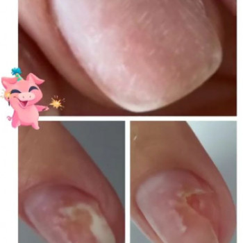 Оніхомікоз
 
 
 
 
 
 