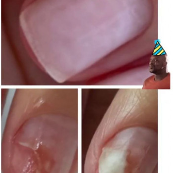 Оніхомікоз
 
 
 
 
 
 